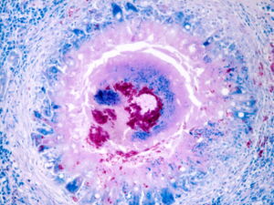 TEM: Granuloma in Tuberculosis with Mycobacterium. Photo: Gudrun Wibbelt/ IZW TEM: Granuloma in Tuberculosis with Mycobacterium. Photo: Gudrun Wibbelt/ IZW